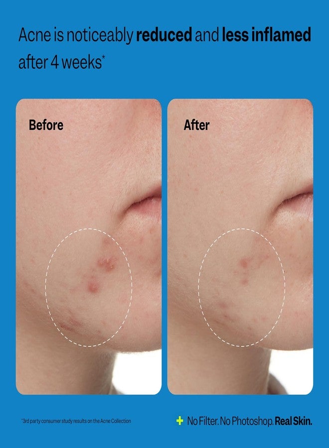 Peach Slices - 3-Step Acne Starter Kit (3 Products) - Skin Care Set - 1 Toner, 1 Cleanser, 1 Oil Free Moisturizer - 2% Salicylic Acid & Botanicals - Vegan & Cruelty Free - Korean Skin Care & Beauty - Image 5